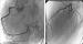 Aktuelles Bild - Abb. 1: Apical Ballooning