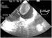 Fig. 2: Transesophageal Echocardiography