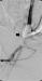 Aktuelles Bild - Abb. 2: Pseudoaneurysma - Ballonokklusion