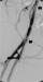 Abb. 4: Stentgraft-Implantation