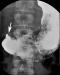 Abb. 1: Morbus Crohn - Duodenum