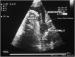 Abb. 6: Flottierender Thrombus