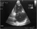 Abb. 9: Endokarditis - Valv. tricuspidalis