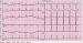 Abb. 1: Normofrequenter Sinusrhythmus