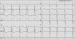 Abb. 2: Intraventrikuläre Dyssynchronie
