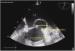 Aktuelles Bild - Abb. 2: Intrakardiales Pseudoaneurysma