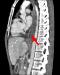 Abb. 2c: Coronale MDCT-Rekonstruktion der Fistel