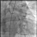 Abb. 4: Saphena Vena Graft auf die Arteria circumflexa (RAO 60°/0°)