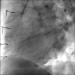 Abb. 6: Saphena Vena Graft auf die rechte Kranzarterie (RAO 60°/0°)