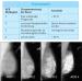 Aktuelles Bild - Abb. 1: Mammographie - ACR