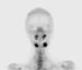 Abb. 2: Osteomyelitis
