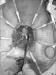 Aktuelles Bild - Abb. 2: Invance-Mesh