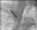Abb. 5: Postdilatation