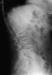 Abb. 3: Osteoporose - Radiologie