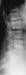 Abb. 6: Osteoporose - Radiologie