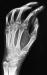 Abb. 7: Osteoporose - Radiologie