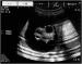 Abb. 1: Ovary - Cyst