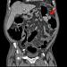 Abb. 1a: Colon descendens - Tumor
