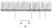 Fig. 1: ECG - PMI5 group.
