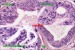 Abb. 3: Hochgradige prostatische intraepitheliale Neoplasie