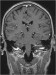 Abb. 10: Arteria cerebelli - Nervus vagus - Nervus glossopharyngeus