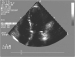 Aktuelles Bild - Abb. 11: Echokardiographie - Vierkammerblick