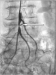 Abb. 1: Arteria mesenterica superior - Stenose