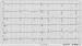 Aktuelles Bild - Abb. 1: EKG