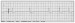 Abb. 2: EKG