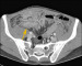 Abb. 1: MDCT - Ileum