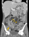 Abb. 2: Ileum - Mesenterium