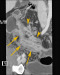 Aktuelles Bild - Abb. 3: Neoterminales Ileum
