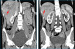 Aktuelles Bild - Abb. 2a-b: Leberruptur