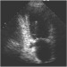 Abb. 1: Transthorakales Echo