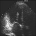 Abb. 2: Transthorakales Echo