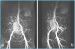 Aktuelles Bild - Abb. 1a-b: MR-Angiographie - A. iliaca communis