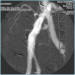 Abb. 3: Angiographie - A. iliaca communis