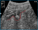 Abb. 1: Sonographische Darstellung eines Divertikels im Colon sigmoideum