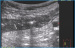 Abb. 2: Sonographie einer entzündlich verdickten Darmwand
