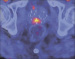 Abb. 1: F18-Cholin-PET mit CT-Fusion