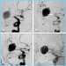 Abb. 8a-d: Ballon-Angioplastie