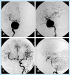Abb. 10a-d: Therapeutischer endovaskulärer Gefäßverschluß