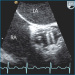 Abb. 8: Transösophageales Echo - Aortenklappe