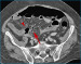 Abb. 2: Colon sigmoideum