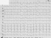 Abb. 1: EKG