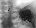 Abb. 2: VNS-Therapie