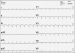 Abb. 1: EKG