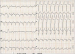Abb. 1: EKG