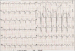 Abb. 3: EKG
