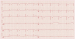 Abb. 1: EKG